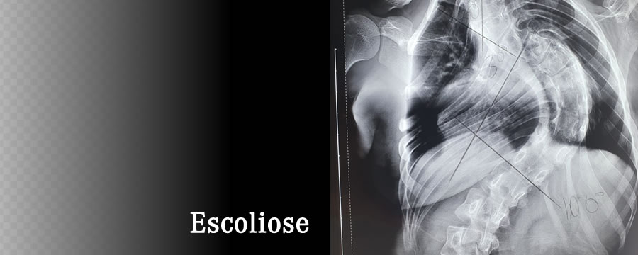 Escoliose: você sabe se seu filho tem?