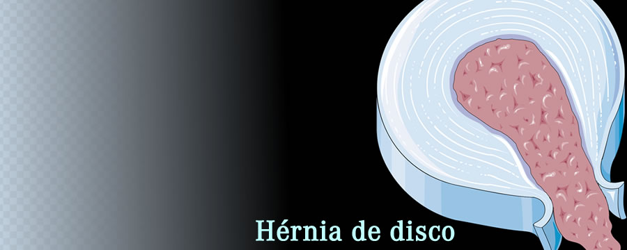 Hérnia de disco e ciático: nossos recordes e as atividades diárias