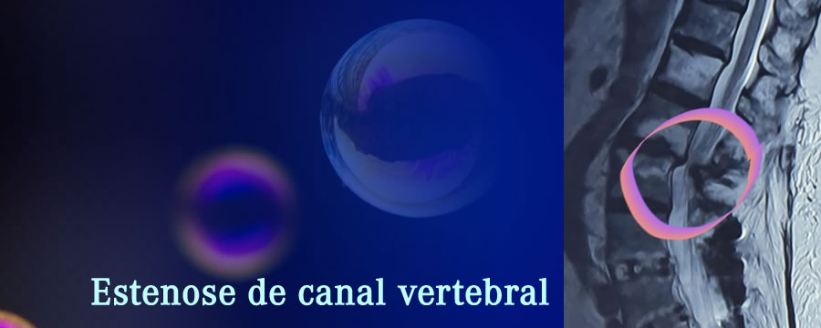 Estenose do canal vertebral: uma máquina complexa em tempos modernos